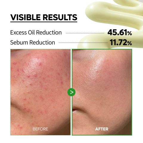 S-ZINC Blemish Cream - Dr.Melaxin.us